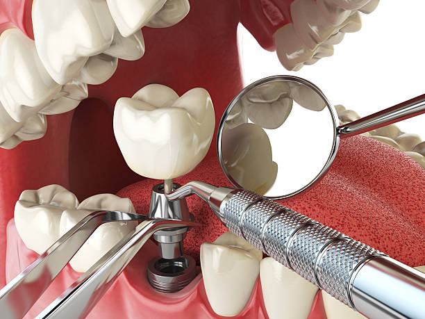 Best Emergency Root Canal Treatment in Macon, IL